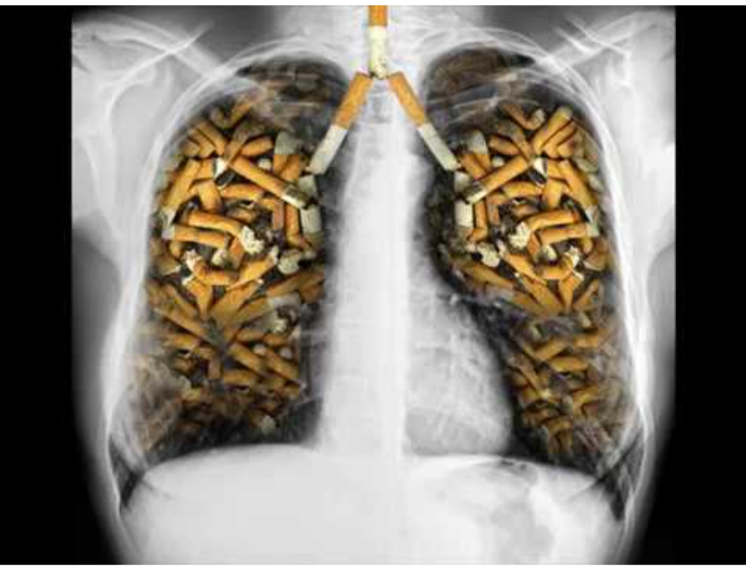 ENFISEMA PULMONAR